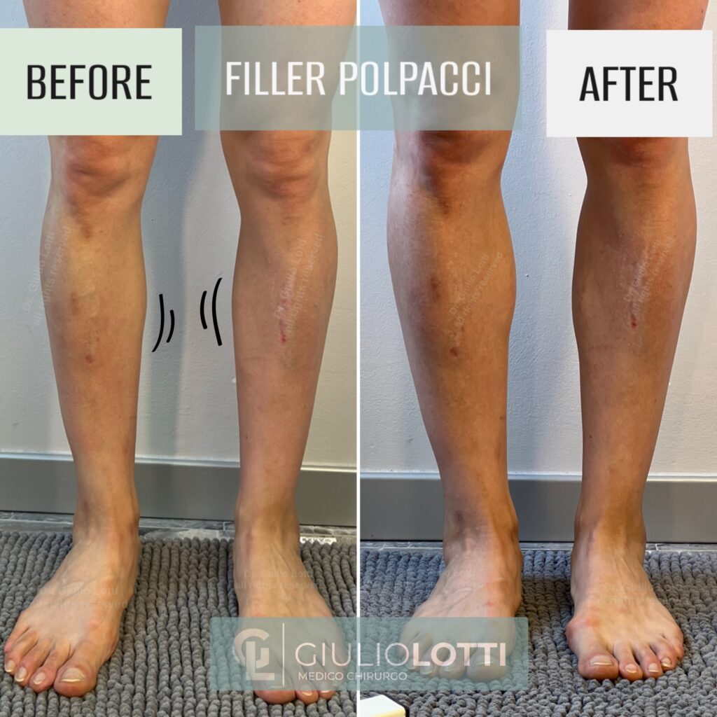 Trattamento medico per eliminare la cellulite e migliorare aspetto dei polpacci– Dott. Giulio Lotti