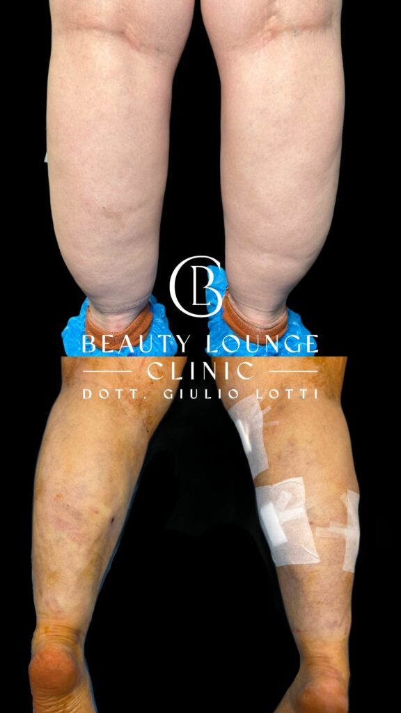 Riduzione Grasso Localizzato- Dott. Giulio Lotti