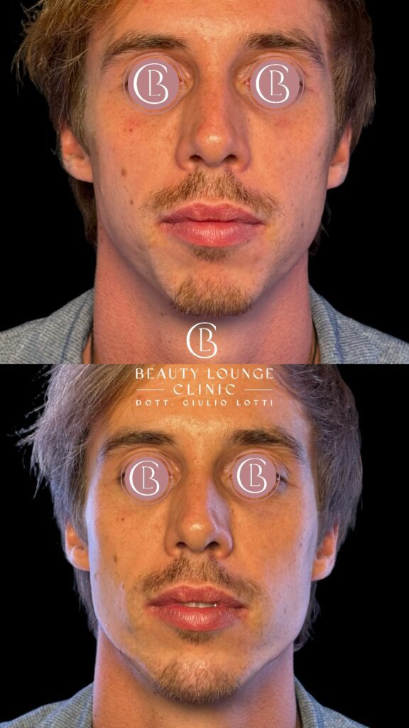 Mascolinizzazione volto uomo - Full face | Dott.GIulio Lotti Full Face- Dott. Giulio Lotti