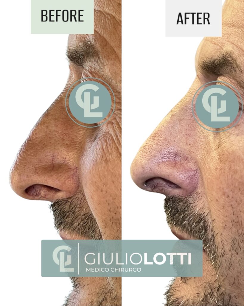 Rino filler 3 | Dott.GIulio Lotti