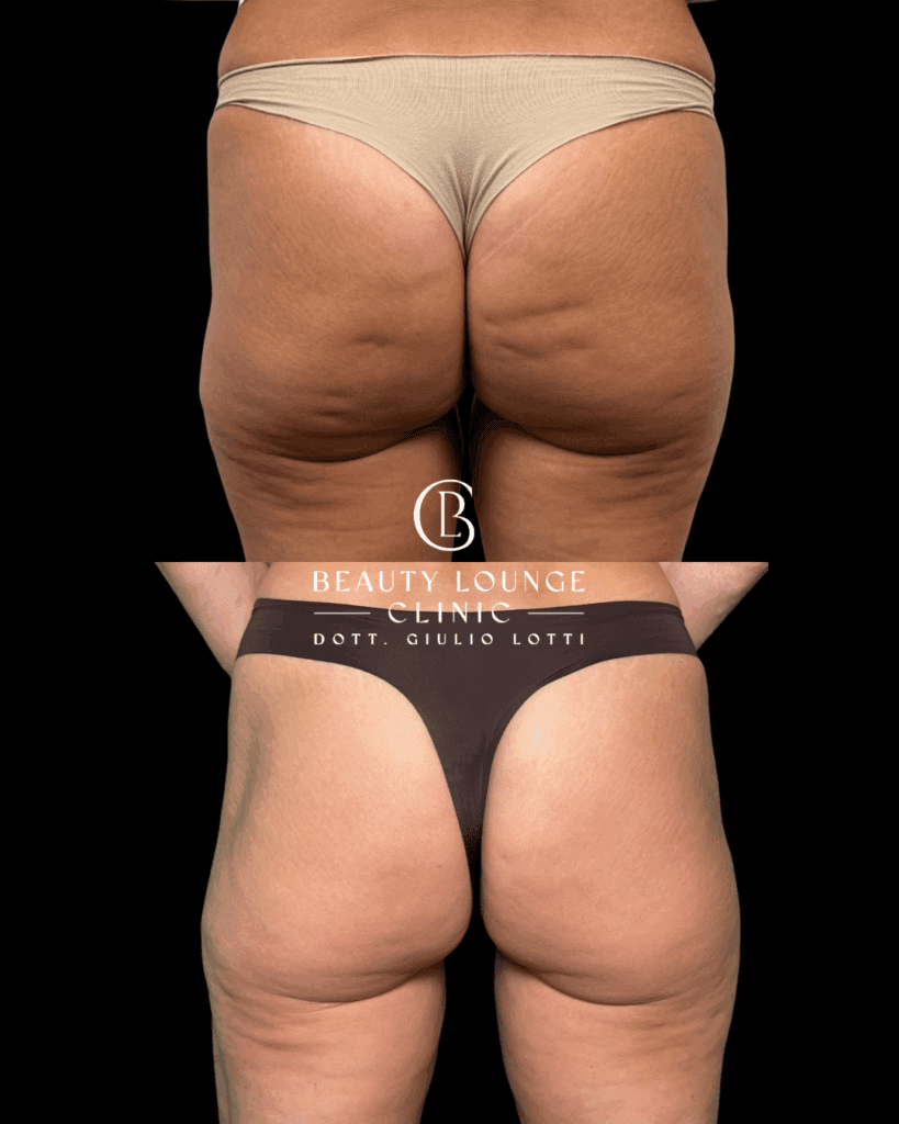 Trattamento medico per eliminare la cellulite e migliorare glutei e cosce – Dott. Giulio Lotti