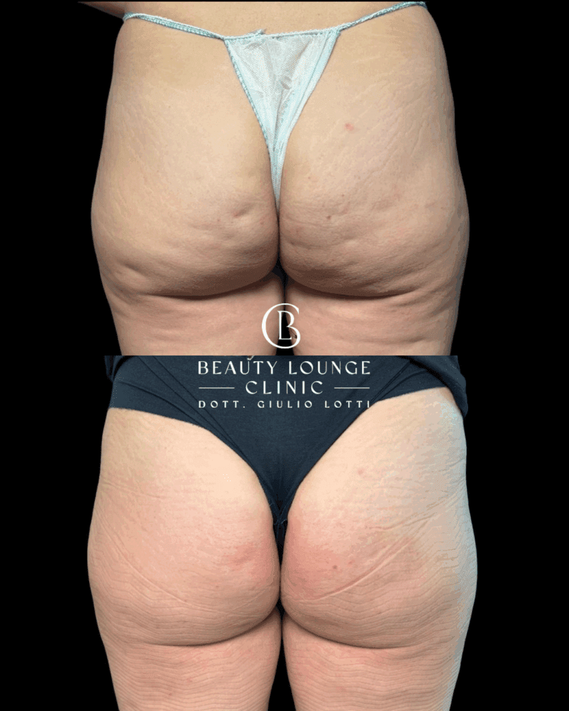 Trattamento medico per eliminare la cellulite e migliorare glutei e cosce – Dott. Giulio Lotti