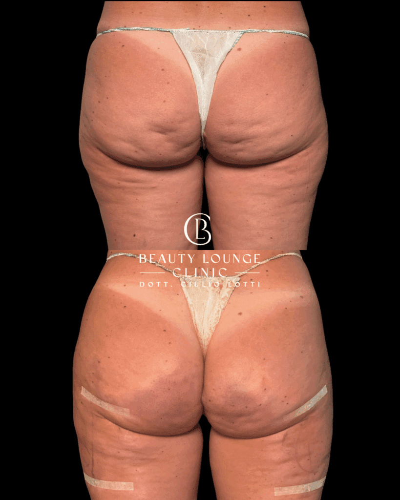 Trattamento medico per eliminare la cellulite e migliorare glutei e cosce – Dott. Giulio Lotti