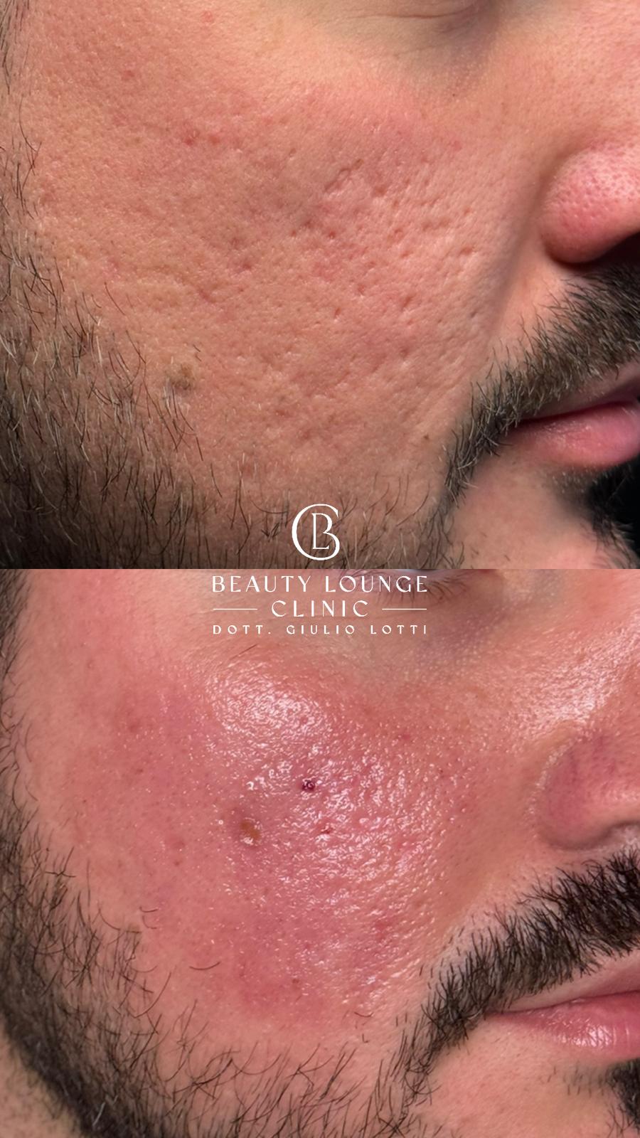 Acne: cause, infiammazione e possibili esiti su macchie e cicatrici