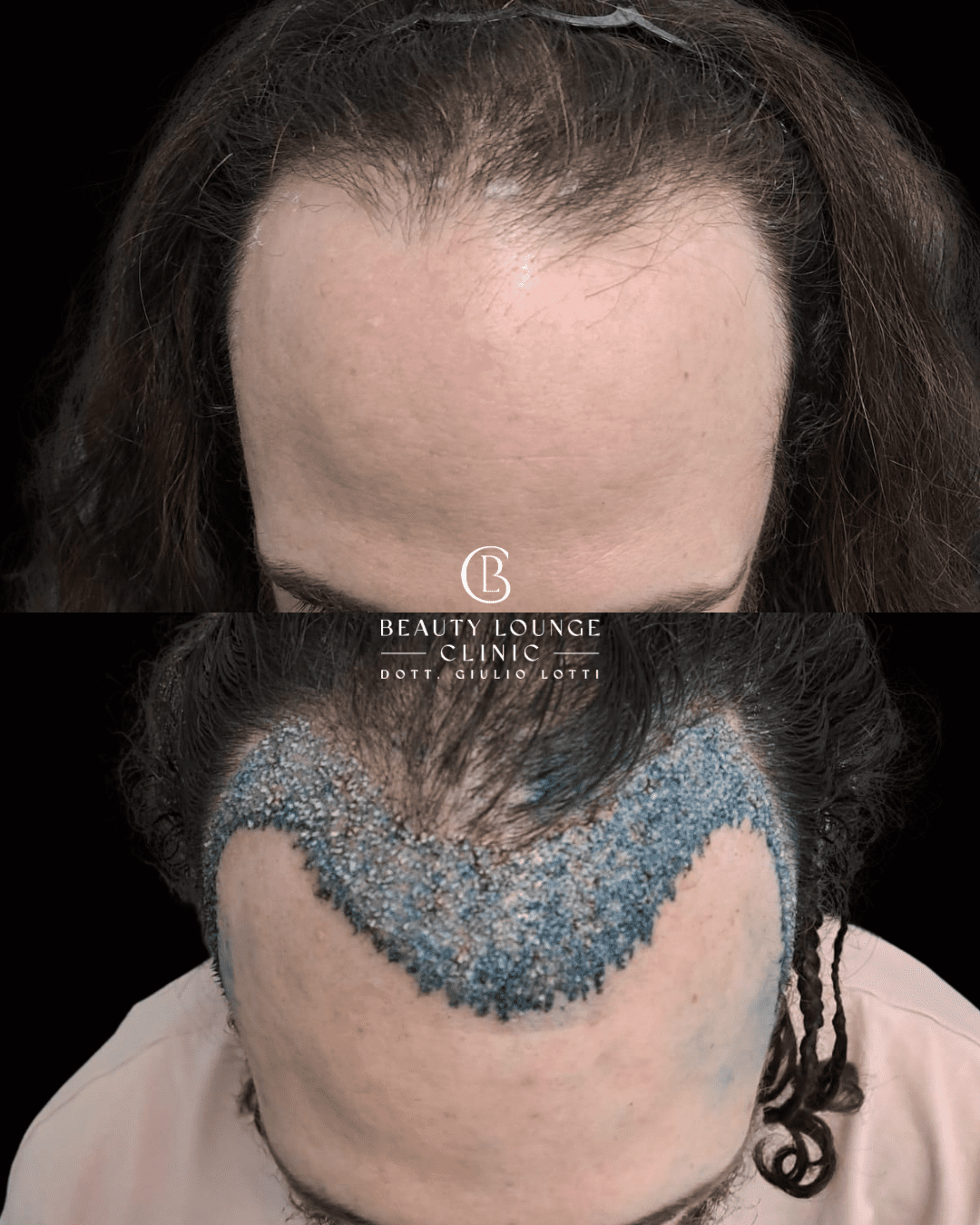 Perdita di capelli e diradamento - trattamenti tricologici