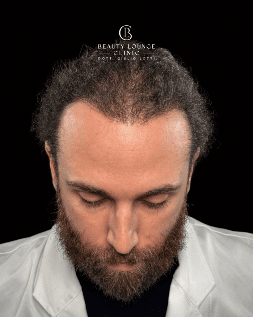 Dott Giulio Lotti- Trattamenti anticaduta